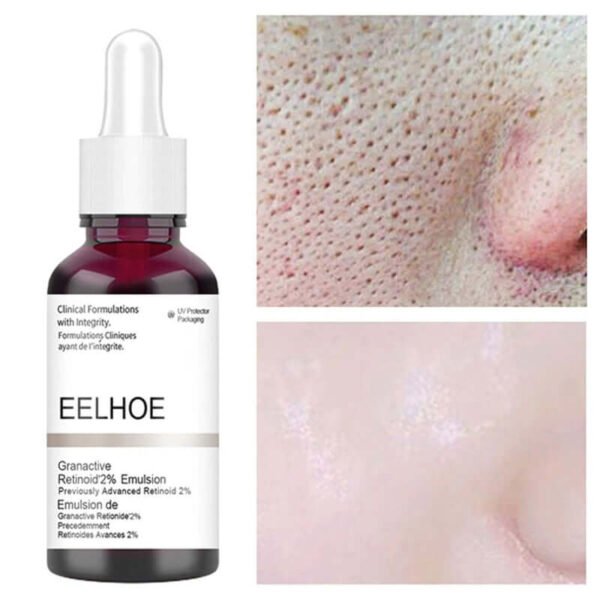 Anti Acne Exfoliating Face Serum